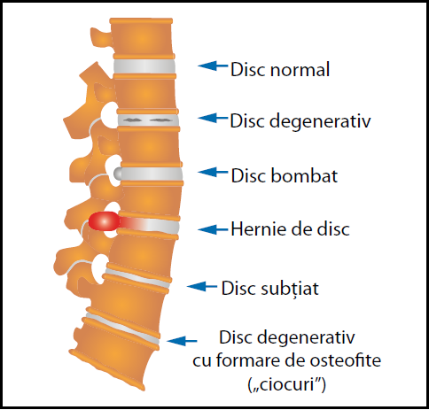Cum tratam hernia de disc fara operatie? | Move&Flex