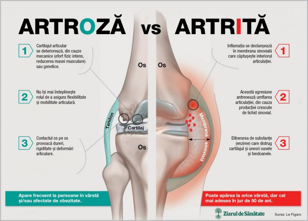 tratamentul artrozei cu artrita