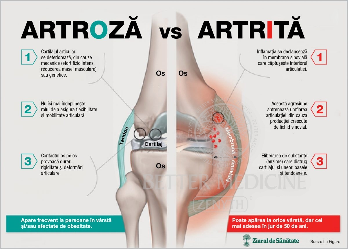 artrita și artroza tratament la rece)