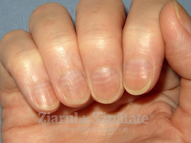 inflamație articulară pe degetul mic al mâinii deformări articulare
